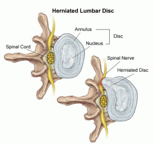 Herniated Disc Graphic(1)